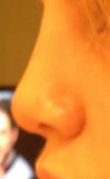 Still so swollen from the side and between my eyes