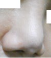 nose after removing silicone; replaced with gote-tex