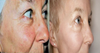 Total FX Before and After Photos
