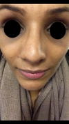 After Septorhinoplasty. crooked/asymmetric.