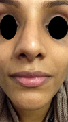 After Septorhinoplasty. crooked/asymmetric.
