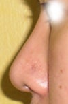 3-month post-op pic with diced rib cartilage rhinoplasty