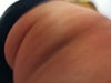 Line on rt thigh