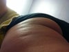 Dimpling on left thigh