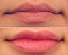 Prevelle before & after photos