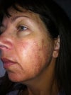 Result after 1st treatment