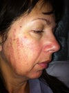 Result after 1st treatment