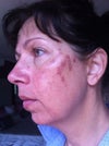 Result after 2nd treatment 48 hours after