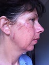 2nd treatment 48 hours after