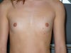 Want to be small and as natural as possible- just want a second opinion on high profile or moderate.
