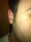 the ear which didnt have surgery