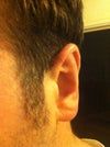 ear that had surgery