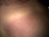 this patch has remained red appeared several weeks and does not respond to steroids.