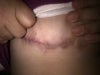 This is the scar beneath the breast. The other breast scar is healed with no red.
