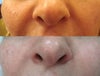 Teosyal before & after photos