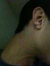 How much would it cost me to have my ear look normal Philadelphia,Pennsylvania