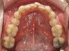 bottom teeth