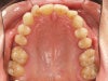top teeth