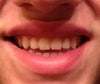 Also when I smile my lip makes this indentation and I hate that.