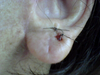 Left earlobe after surgery