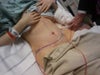 24 hours out of surgery