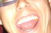 Heres  better lighted picture of my bulging nostril!