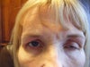 Ptosis left eye lid. 5+ weeks.No eye involvement. No other symptoms.