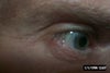 My lower eyelids are so bulding with what appear to be bumps but are really just loads of criss-crossing wrinkles.  None of which I ever had before Juvederm.  I believe it migrated to my eyelids and hardened in waves.  Can this be determined by a certain type of doctor?