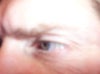 This is a current picture of the large wave-like wrinkles that formed on my eyelids after getting Juvederm under both eyes without my permission.  I just wanted the one wrinkles traced.  The injecting doctor wants to give Botox to ease the wrinkles, in this area, but I feel that it is only masking the problem.  I already had Botox over my entire face to mask the severe wrinkles that formed all down my cheeks.  I don't know if they will go away when the Juvederm wears off or if it is permanent damage?  Should I look into eyelid surgery?
