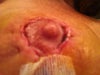 Right nipple, 1 week after