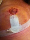 Right nipple, different view