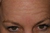 Botox wearing off