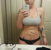 2 days post surgery