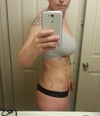 2 days post surgery