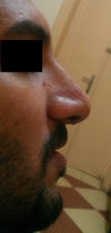 one week postop. just after splint removal