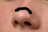 The black line is where my scar is, on the tip or bridge of the nose.