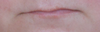 You can see my lips are very thin and on the left side where the scar is the lip is crooked.