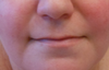 Here, again you can see the left side is crooked from the scar on the lip.