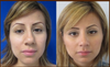 I want nose like here in after picture