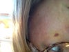 Bruise developed after Belotero injection.