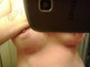 this is to show the incisions and their difference in each other one incision is high while the other is low, will they line up eventually