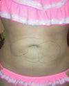 8 moths post op