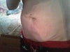 before tummy tuck, you can see the double layer of skin...