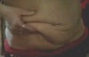 excess skin before tummy tuck