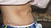 excess skin, side view