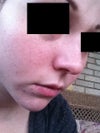 You cant see the redness much in the photo, but I also have major redness around the crease of my nose.