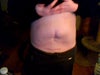 weight 160 prior liposuction pre hernia and rectus diastasis after a colon resection one year ago and emergency repair of knicked intestine.  Healed by secondary intention with a wound vac keloid formations. Also noted lipodystrophy most likely from past liposuctions and losing and regaining so much during my illness.