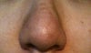 the left side is higher than the left side, no "nose fold" on the left side