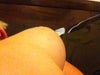 Implant on side