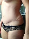 Bulge I'm guessing is scar tissue from the hematoma